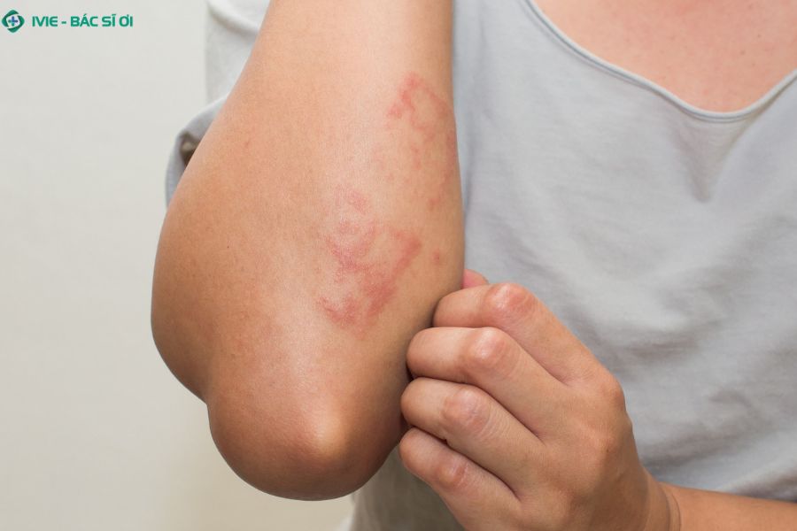 Các bệnh lây truyền qua đường tình dục (STIs) có thể lây lan nhanh chóng nếu không có biện pháp phòng ngừa