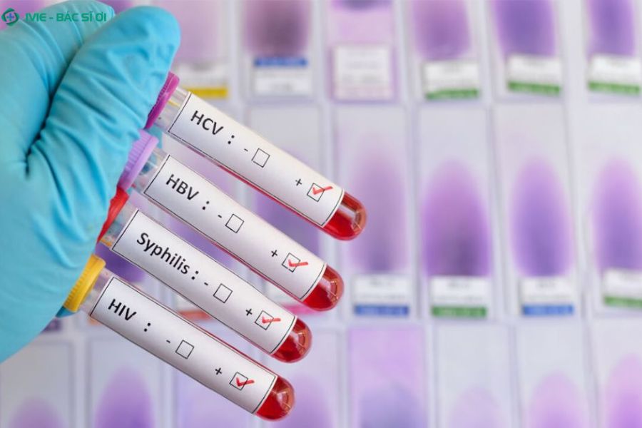 Chủ động xét nghiệm STDs định kỳ là cách tốt nhất để phát hiện sớm và điều trị hiệu quả các bệnh lây truyền qua đường tình dục ở người đồng giới